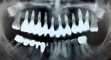 Clínica Dental Pablo Santaolalla radiografía dental